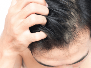 man scratching scalp