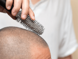 dandruff on comb