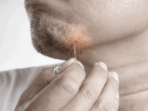 man picking an ingrown facial hair